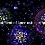 Treatment of knee osteoarthritis